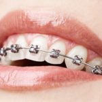 Implantes