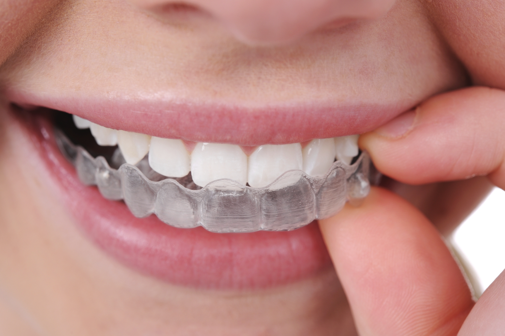 Invisalign-Aligners