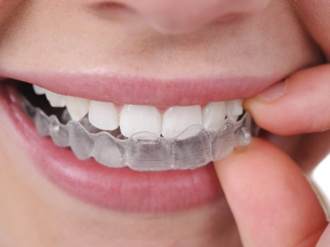 Invisalign-Aligners